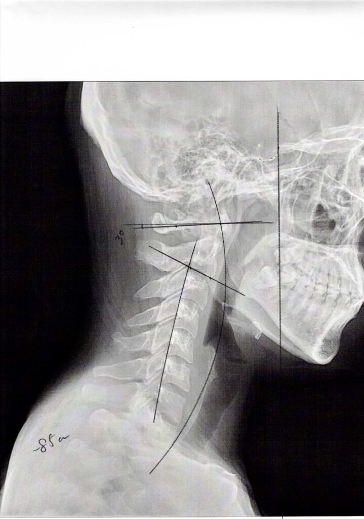 初回レントゲン画像（首：側面）