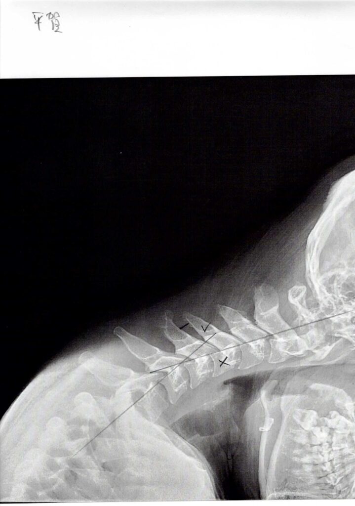 初回レントゲン画像（首：側面下向き）