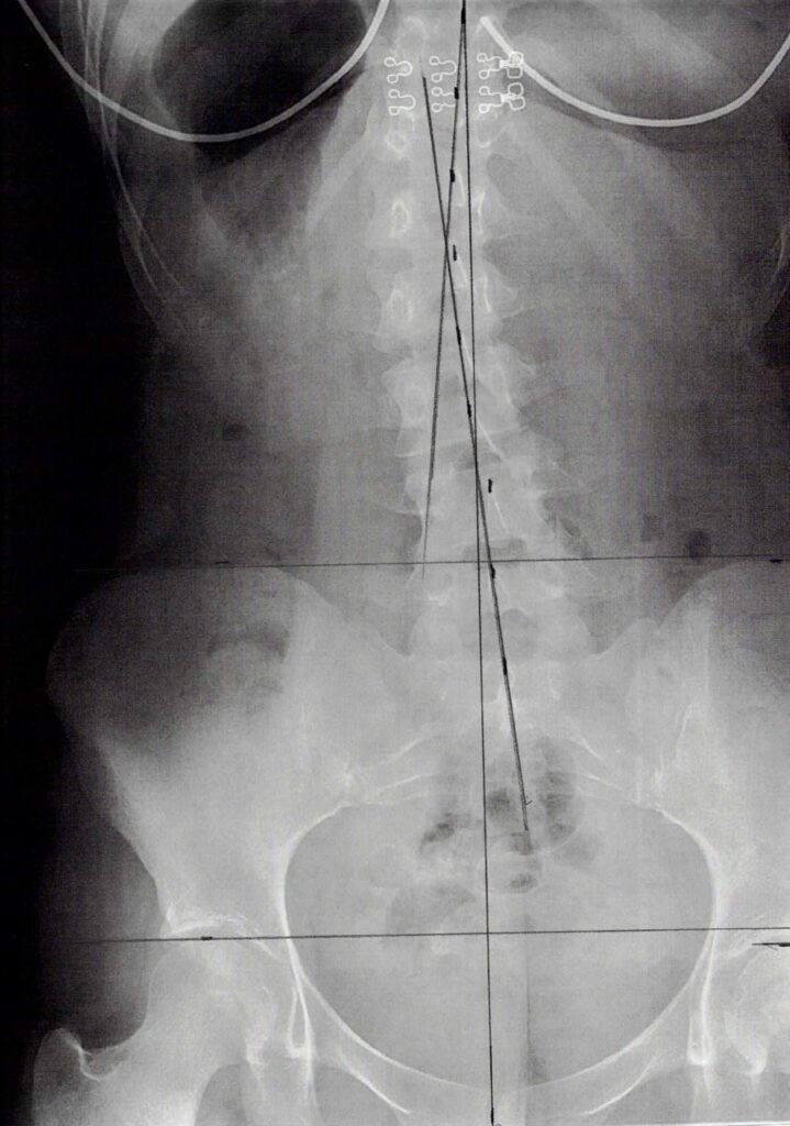 初回レントゲン画像（腰：正面）