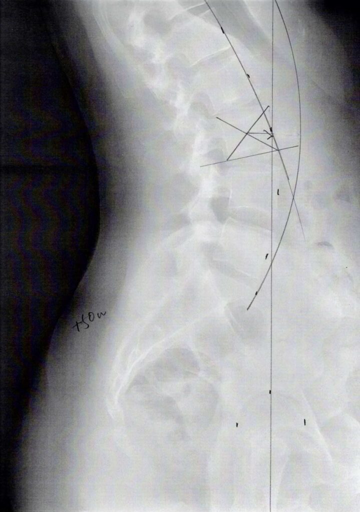 初回レントゲン画像（腰：側面）