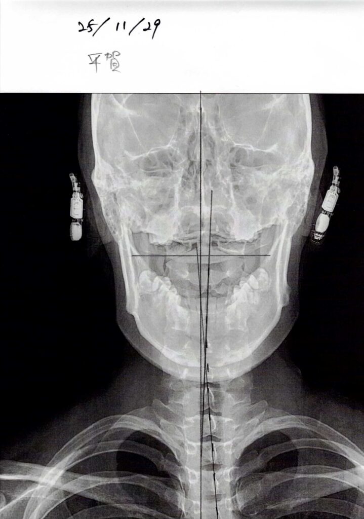 初回レントゲン画像（首：正面）