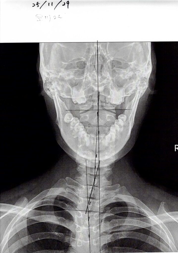 初回レントゲン画像（首：正面）