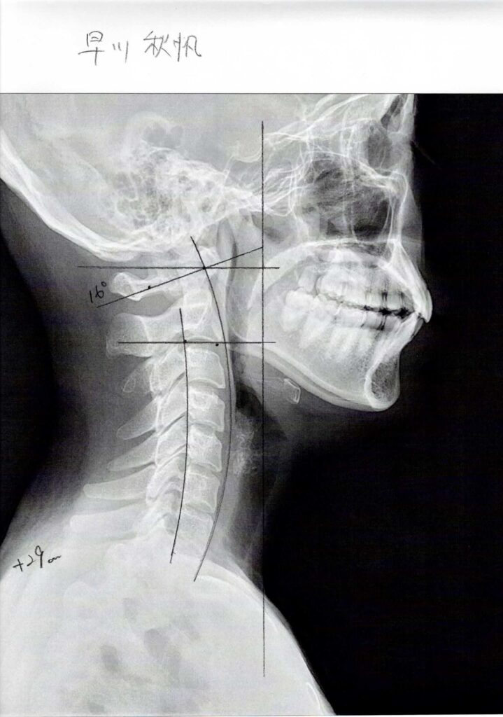 初回レントゲン画像（首：側面）