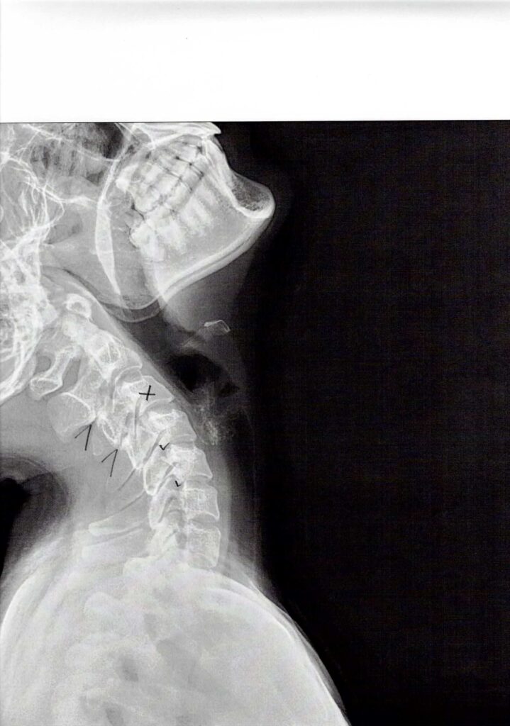 初回レントゲン画像（首：側面上むき）