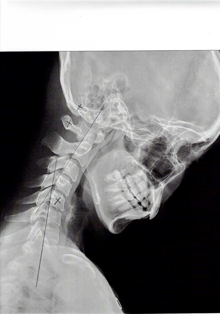 初回レントゲン画像（首：側面下向き）