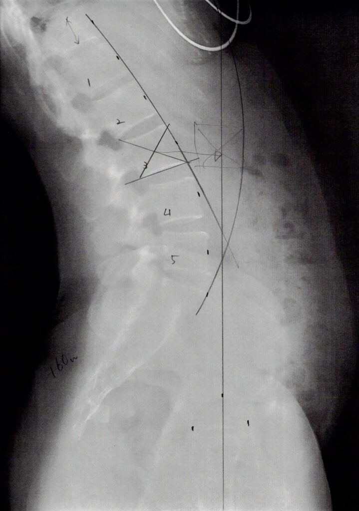 初回レントゲン画像（腰：側面）