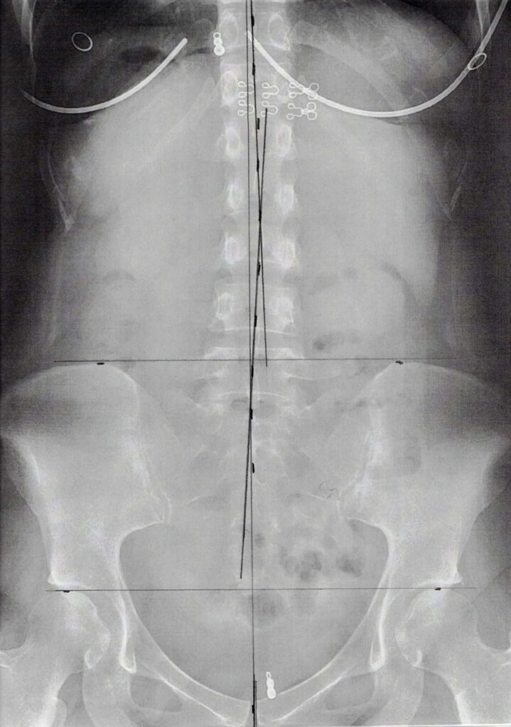 初回レントゲン画像（腰：正面）