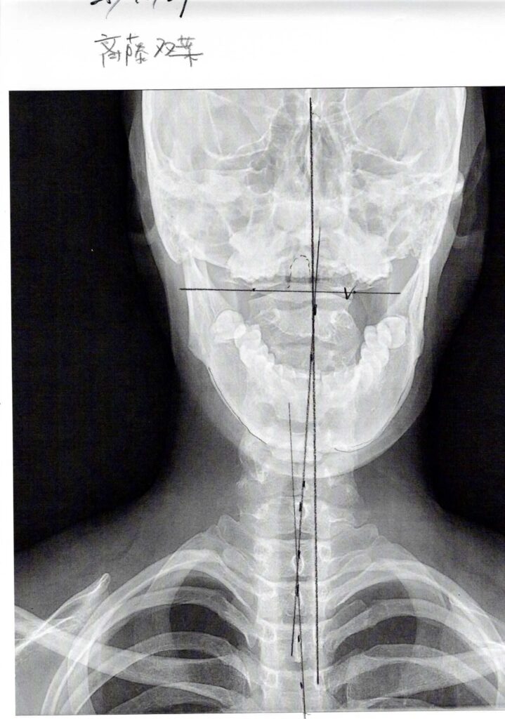 初回レントゲン画像（首：正面）