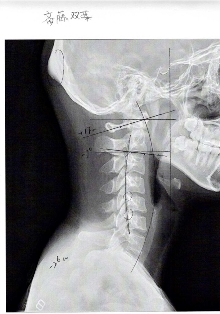 初回レントゲン画像（首：側面）
