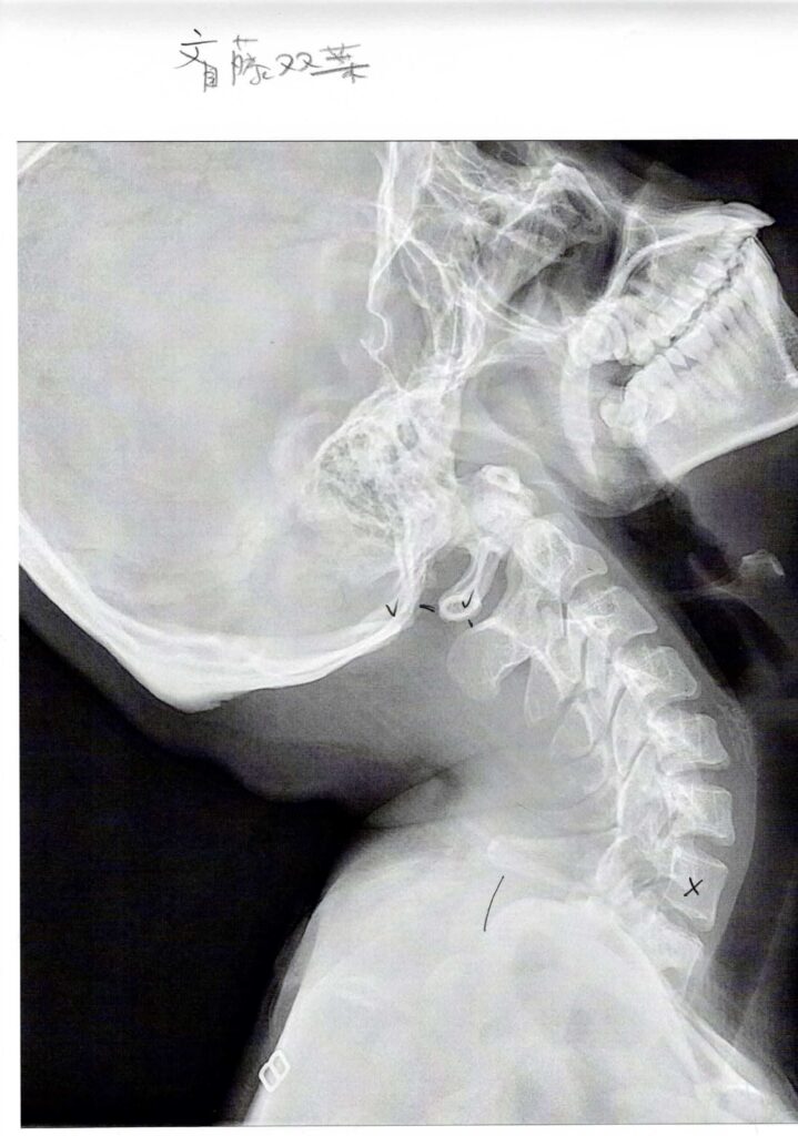 初回レントゲン画像（首：側面上むき）