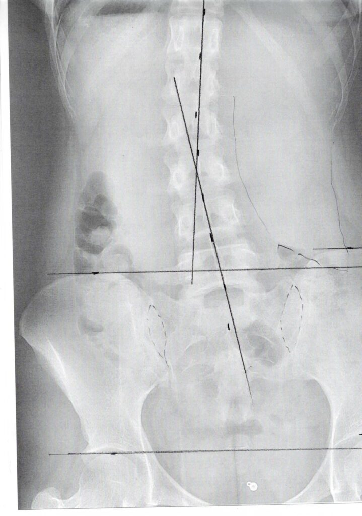 初回レントゲン画像（腰：正面）