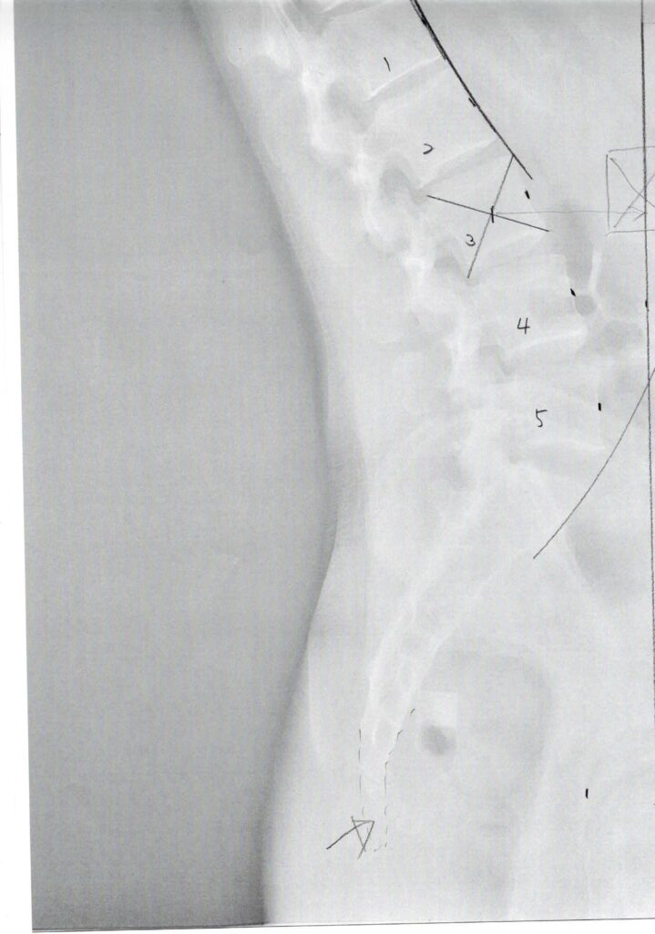 初回レントゲン画像（腰：側面）