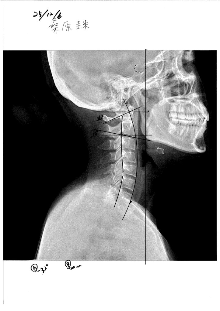 初回レントゲン画像（首：側面）