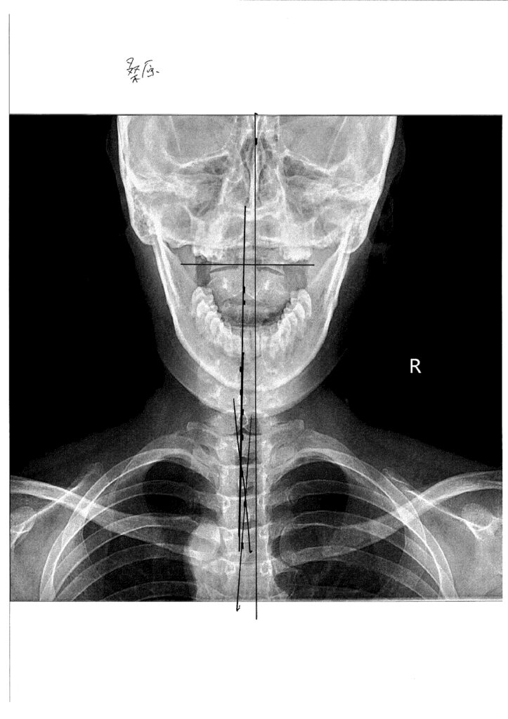 初回レントゲン画像（首：正面）