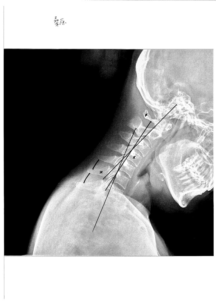 初回レントゲン画像（首：側面下向き）