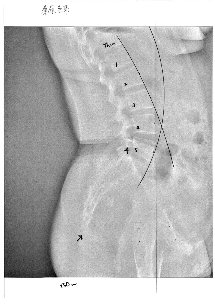 初回レントゲン画像（腰：側面）