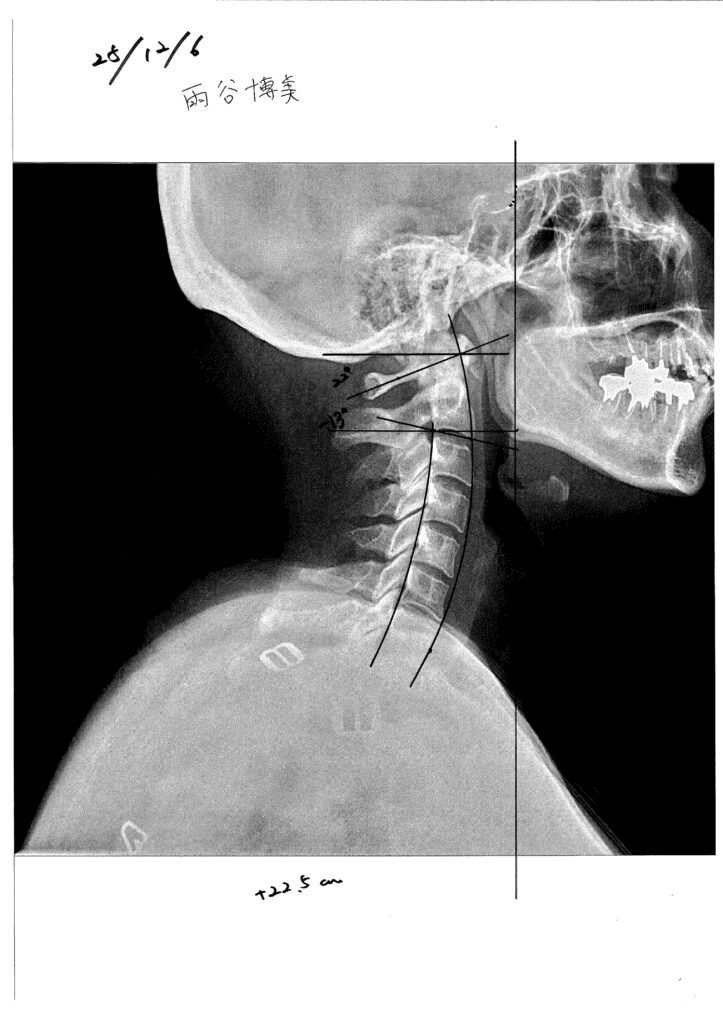 初回レントゲン画像（首：側面）