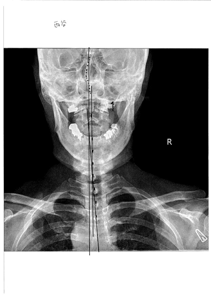 初回レントゲン画像（首：正面）