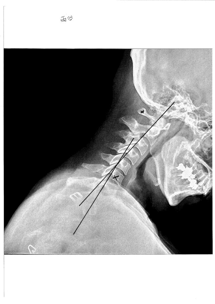 初回レントゲン画像（首：側面下向き）