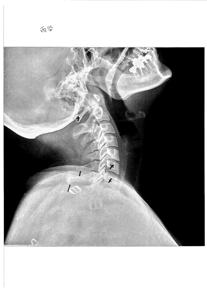 初回レントゲン画像（首：側面上むき）