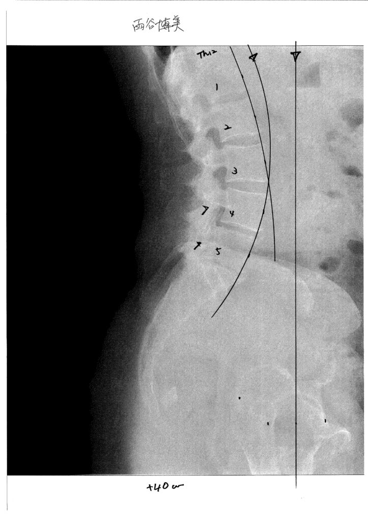 初回レントゲン画像（腰：側面）