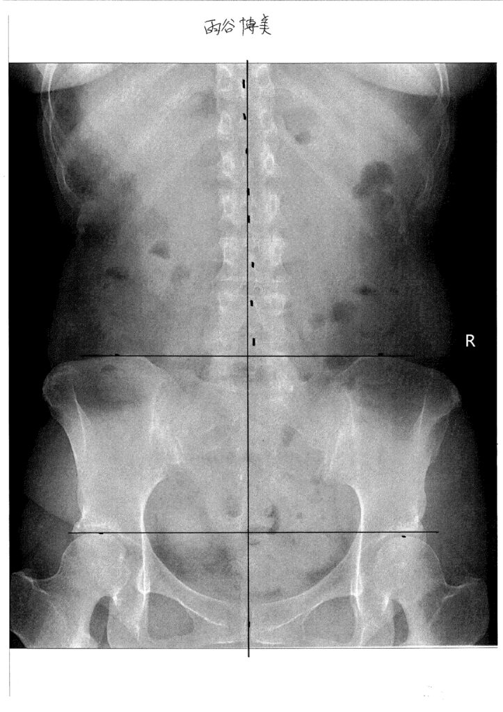 初回レントゲン画像（腰：正面）