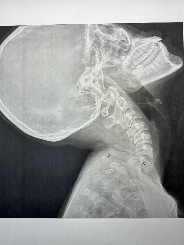 初回レントゲン画像（首：側面上むき）
