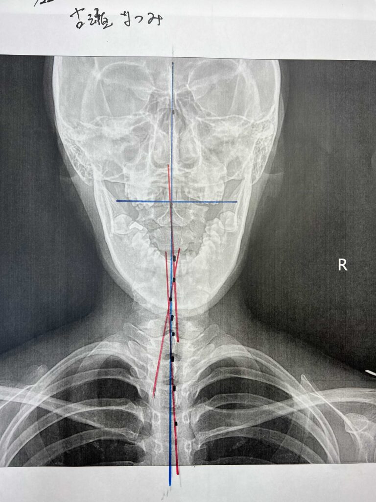 初回レントゲン画像（首：正面）
