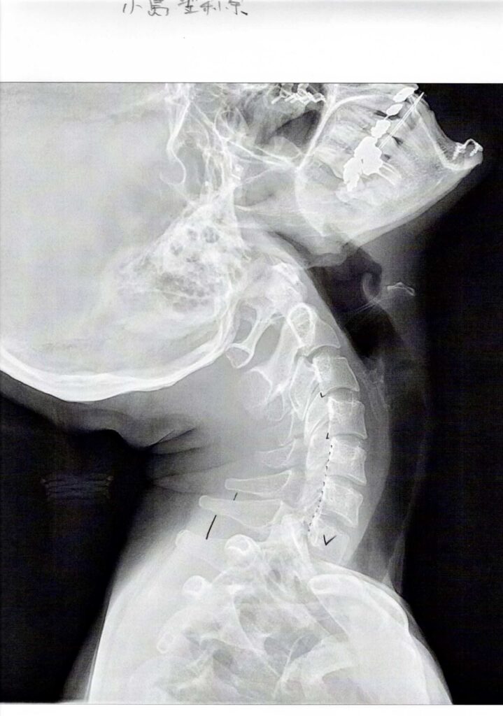 初回レントゲン画像（首：側面上むき）