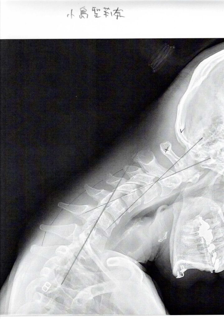 初回レントゲン画像（首：側面下向き）