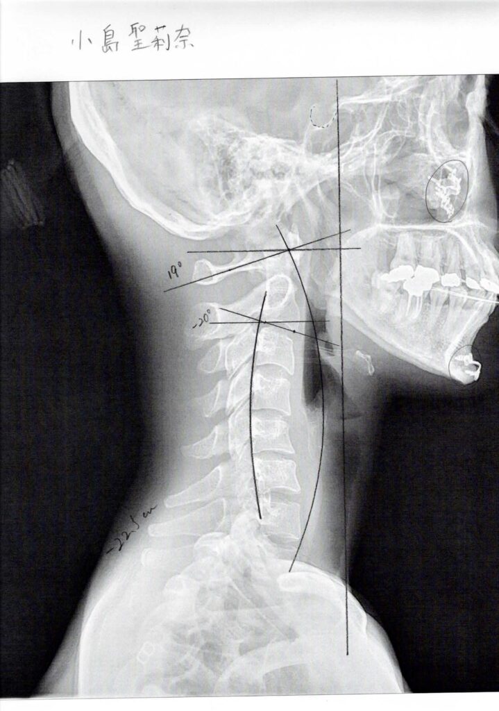 初回レントゲン画像（首：側面）