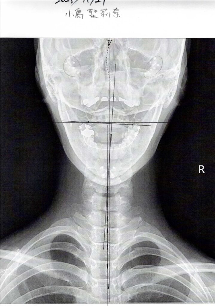 初回レントゲン画像（首：正面）