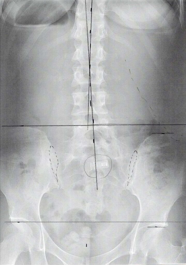 初回レントゲン画像（腰：正面）