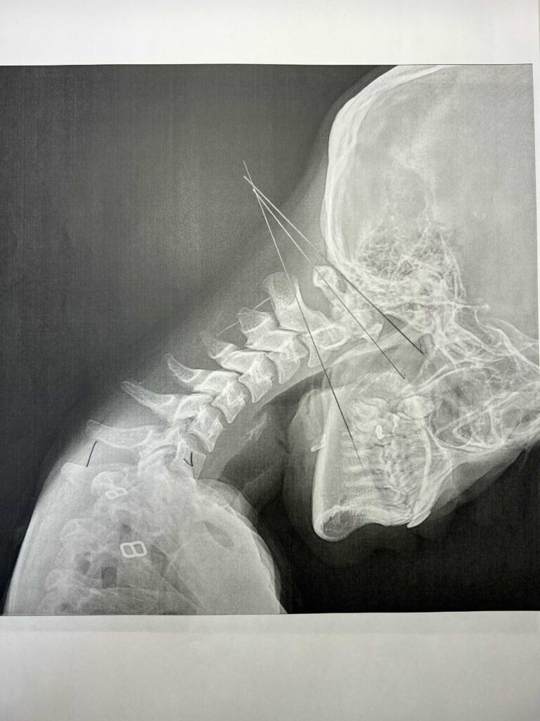 初回レントゲン画像（首：側面下向き）