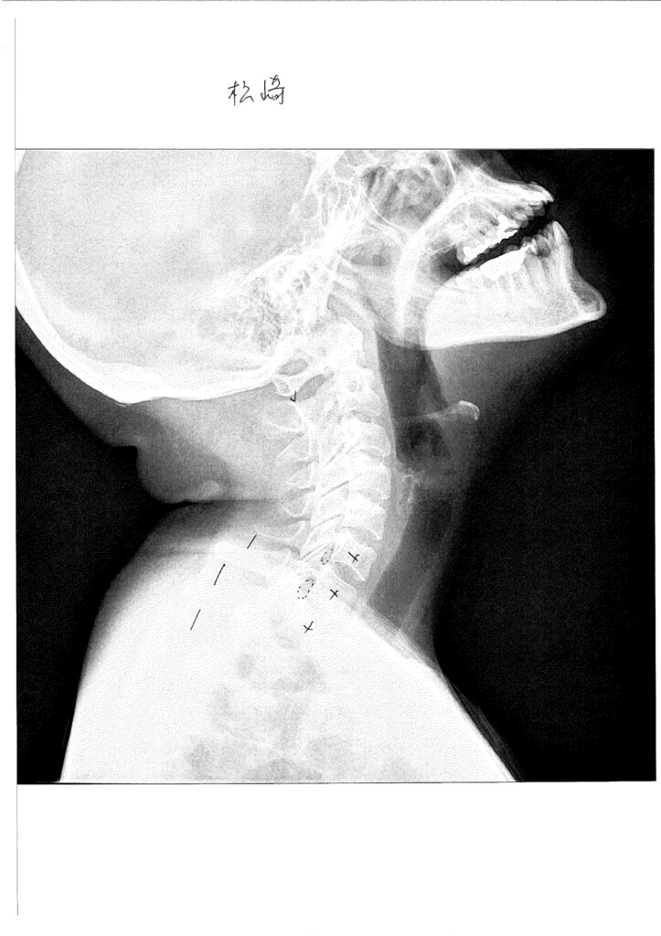 初回レントゲン画像（首：側面上むき）
