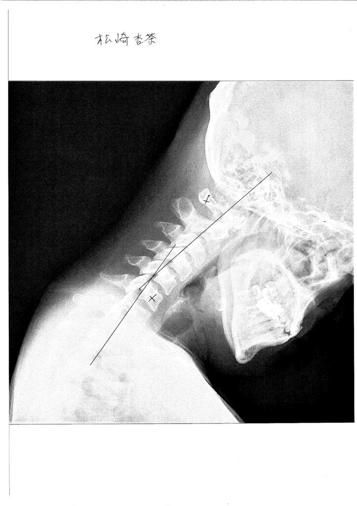 初回レントゲン画像（首：側面下向き）