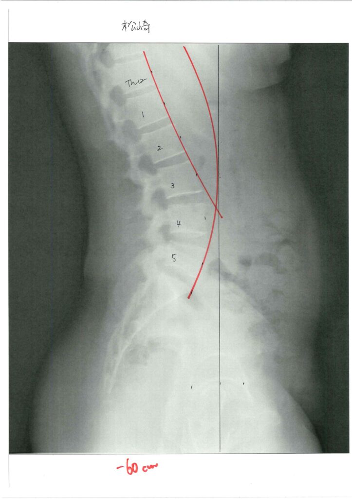 初回レントゲン画像（腰：側面）