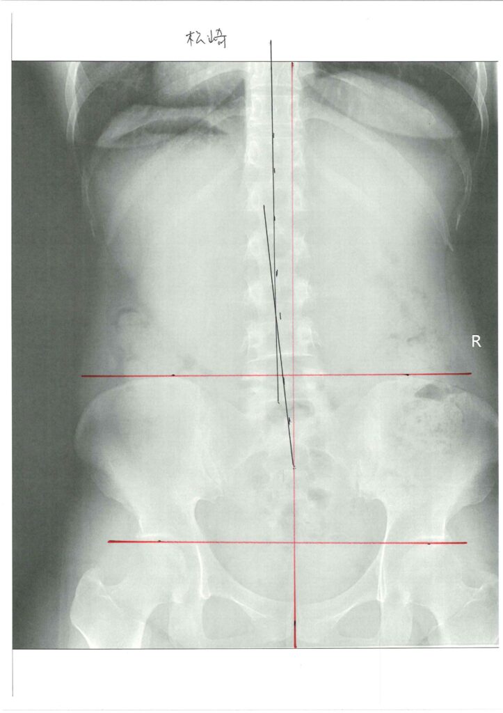 初回レントゲン画像（腰：正面）
