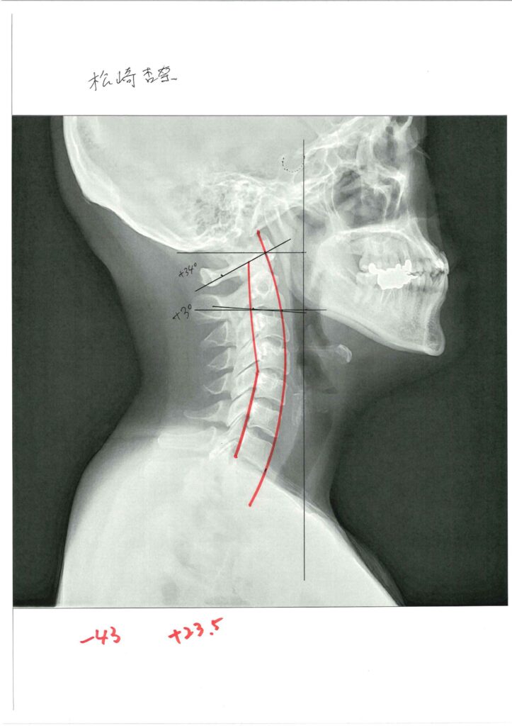 初回レントゲン画像（首：側面）