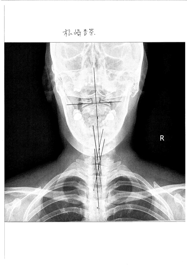 初回レントゲン画像（首：正面）