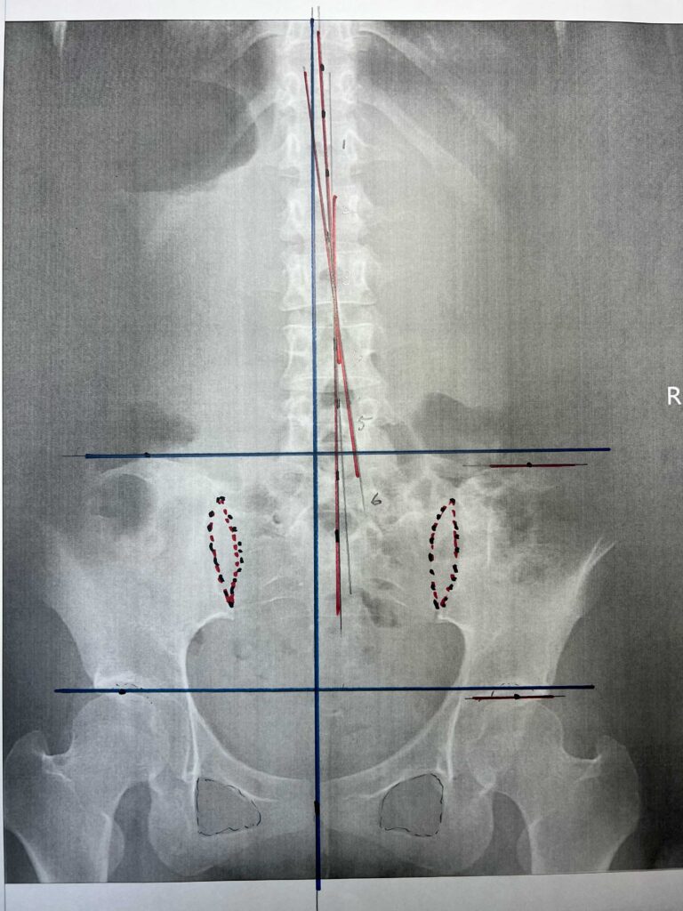 初回レントゲン画像（腰：正面）