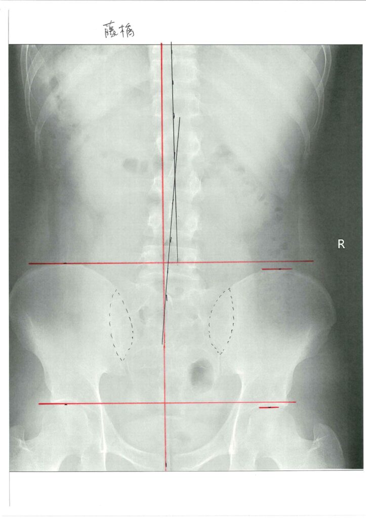 初回レントゲン画像（腰：正面）