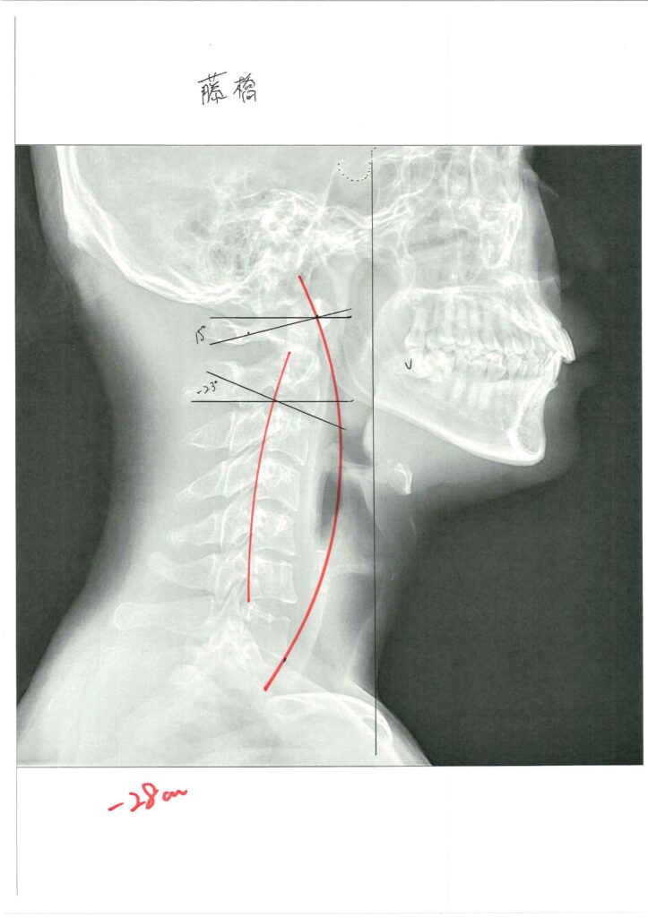 初回レントゲン画像（首：側面）