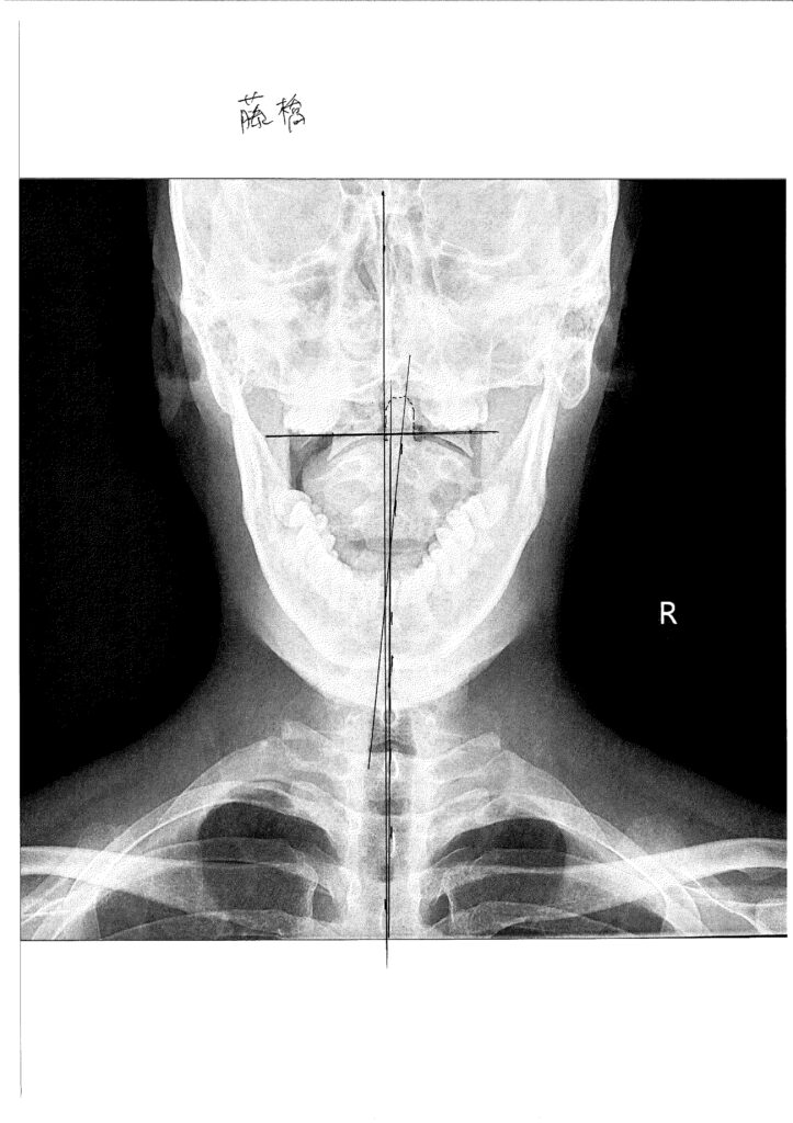 初回レントゲン画像（首：正面）
