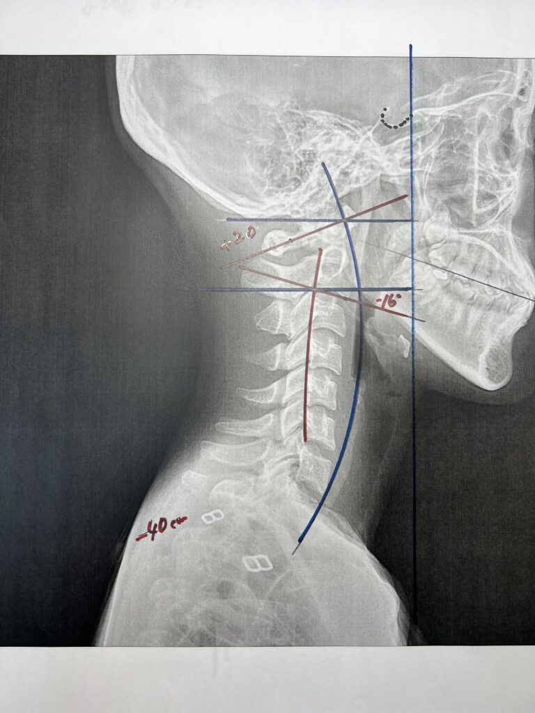 初回レントゲン画像（首：側面）