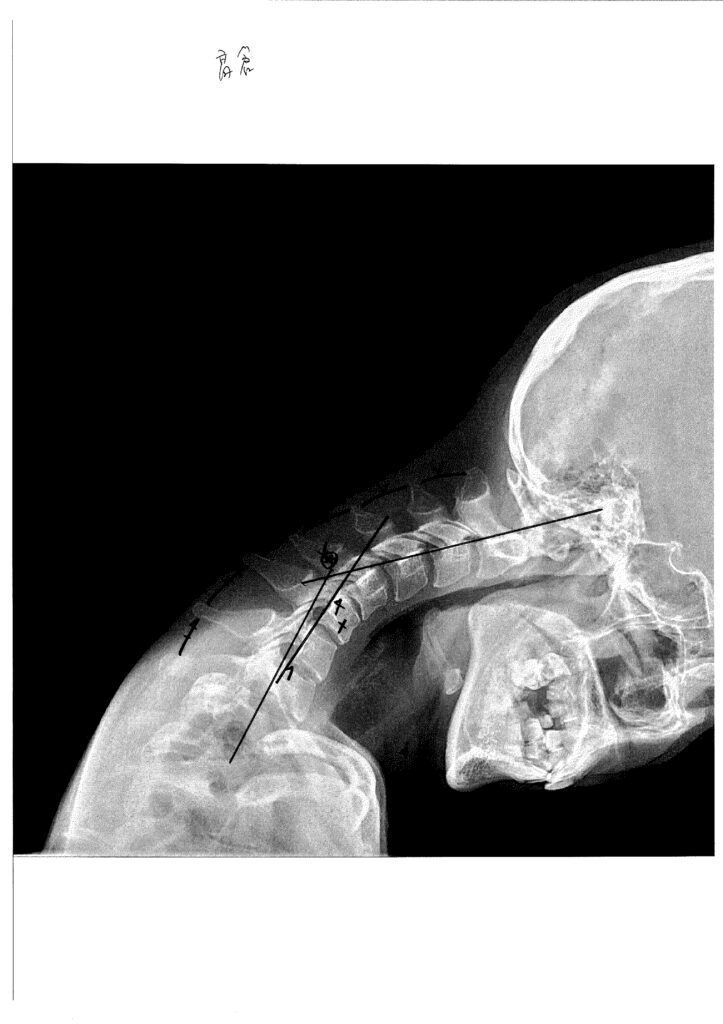 初回レントゲン画像（首：側面下向き）