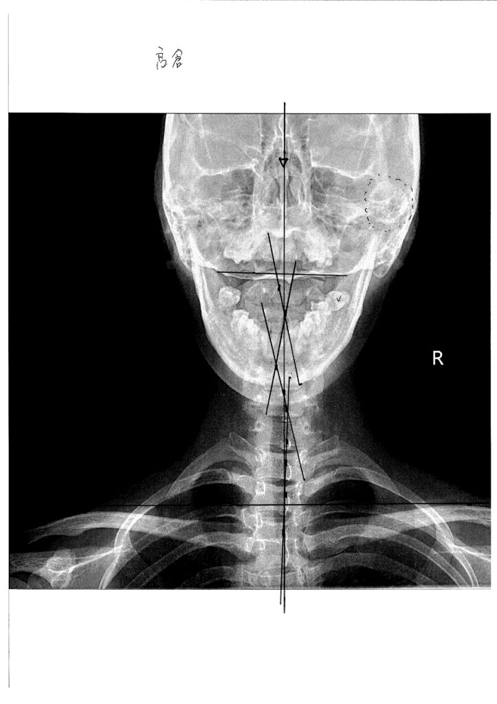 初回レントゲン画像（首：正面）