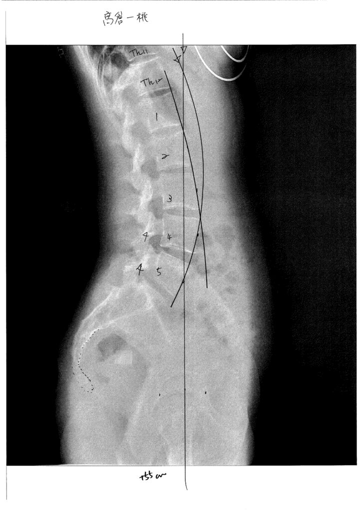 初回レントゲン画像（腰：側面）