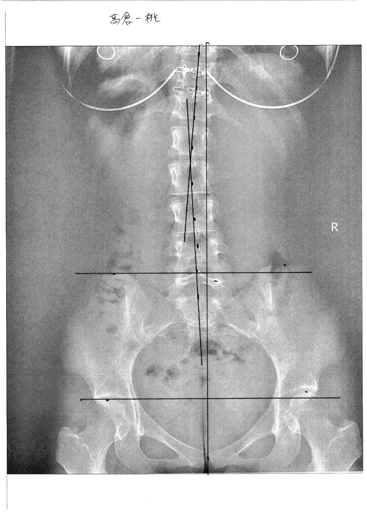 初回レントゲン画像（腰：正面）
