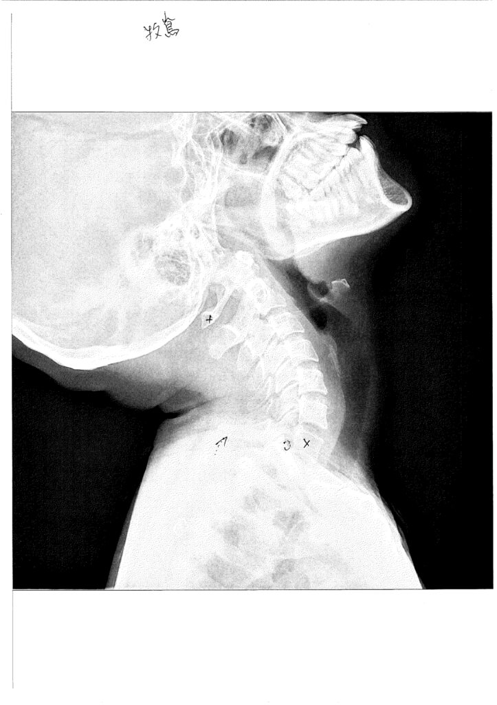 初回レントゲン画像（首：側面上むき）